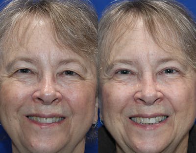 Upper Blepharoplasty Before & After Gallery - Patient 226791 - Image 1