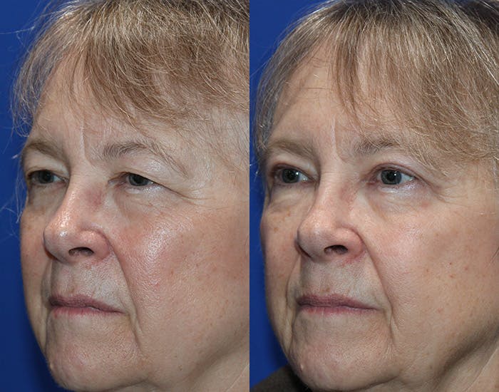 Upper Blepharoplasty Before & After Gallery - Patient 226791 - Image 3