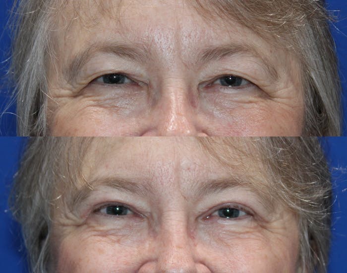 Upper Blepharoplasty Before & After Gallery - Patient 226791 - Image 2