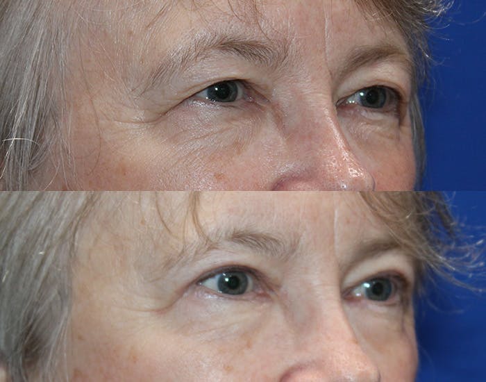 Upper Blepharoplasty Before & After Gallery - Patient 226791 - Image 6