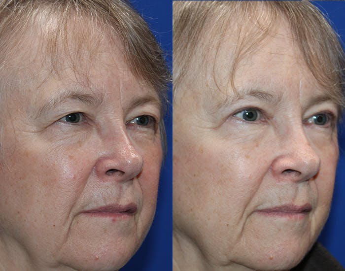 Upper Blepharoplasty Before & After Gallery - Patient 226791 - Image 5