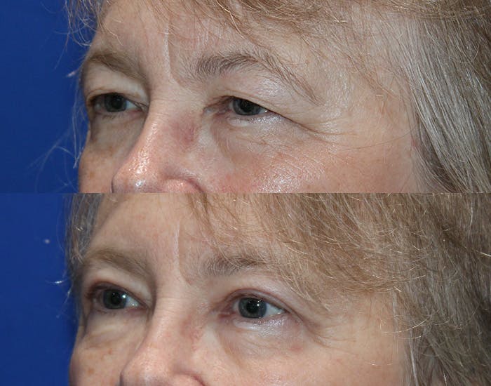 Upper Blepharoplasty Before & After Gallery - Patient 226791 - Image 4