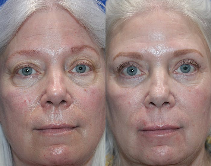 Upper Blepharoplasty Before & After Gallery - Patient 160066 - Image 1