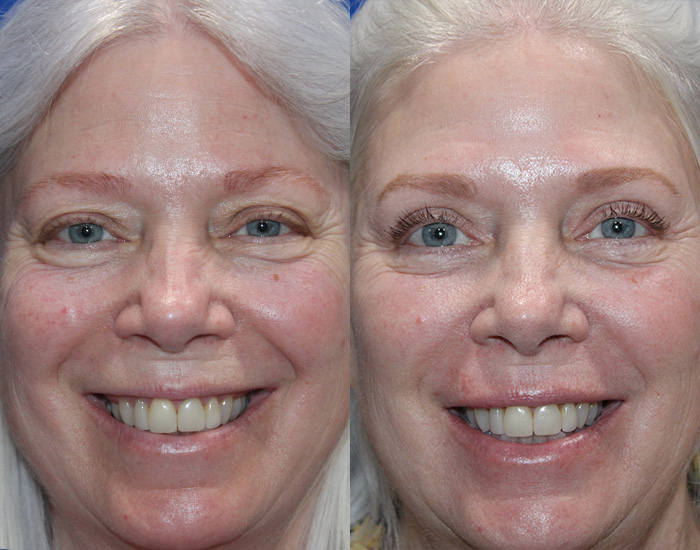 Chemical Peel Before and After Front
