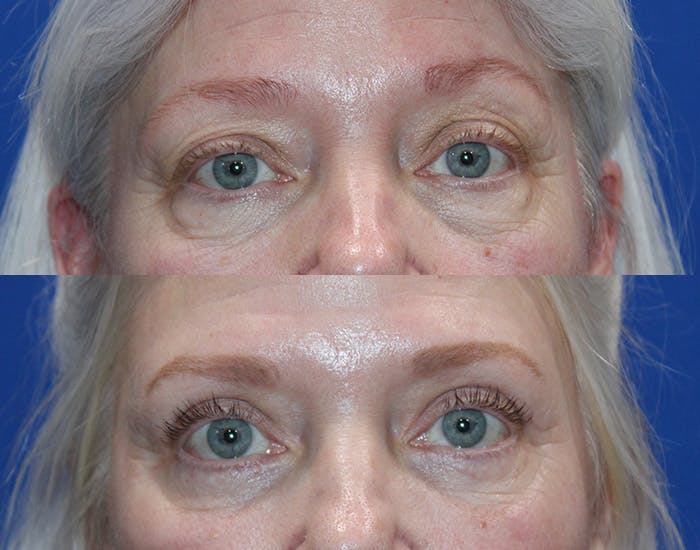 Upper Blepharoplasty Before & After Gallery - Patient 160066 - Image 2