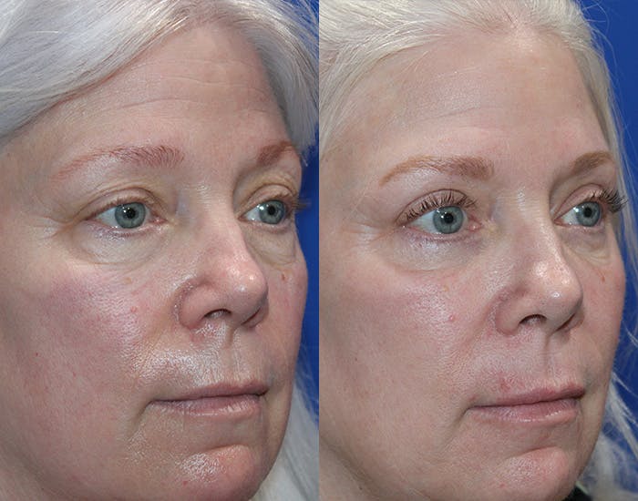 Upper Blepharoplasty Before & After Gallery - Patient 160066 - Image 6