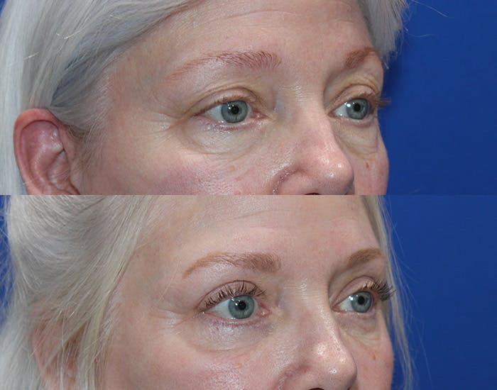 Lower Blepharoplasty Before & After Gallery - Patient 220581 - Image 7
