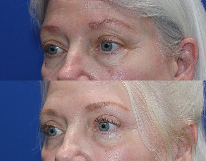 Upper Blepharoplasty Before & After Gallery - Patient 160066 - Image 5