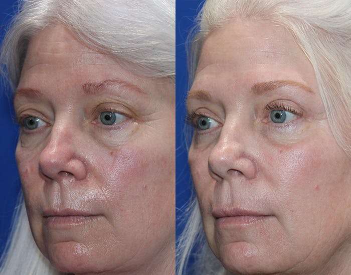 Upper Blepharoplasty Before & After Gallery - Patient 160066 - Image 4