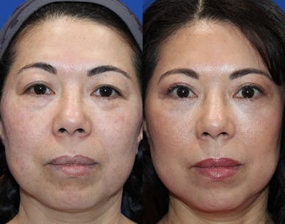 Lower Blepharoplasty Before & After Gallery - Patient 911425 - Image 1