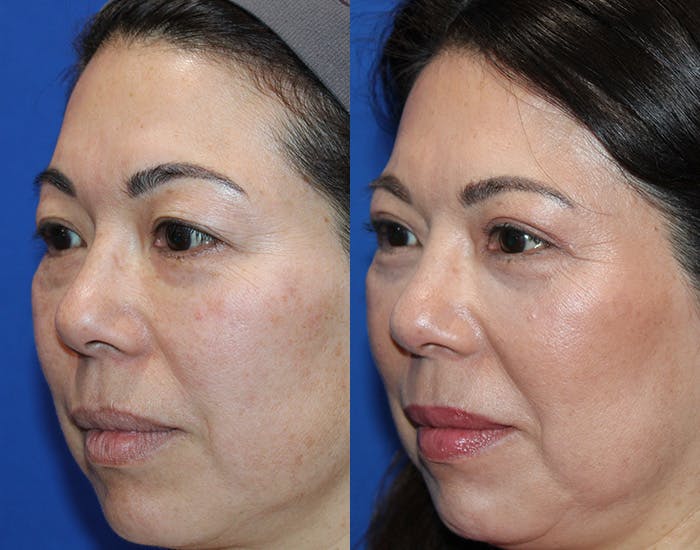 Upper Blepharoplasty Before & After Gallery - Patient 333545 - Image 3