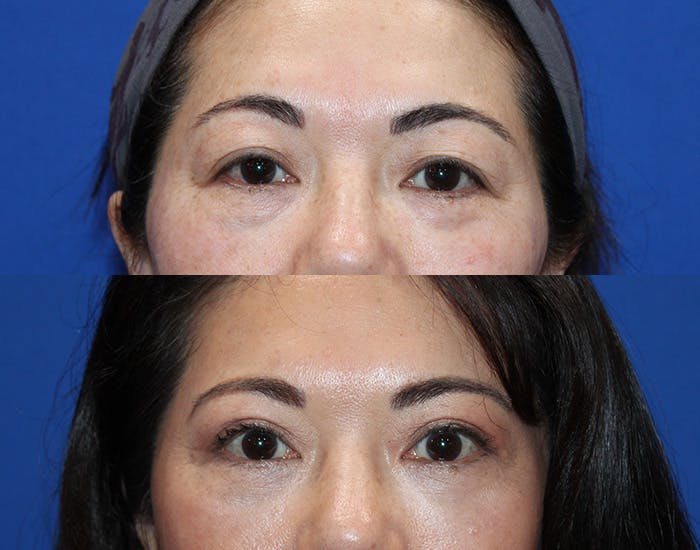 Lower Blepharoplasty Before & After Gallery - Patient 911425 - Image 2