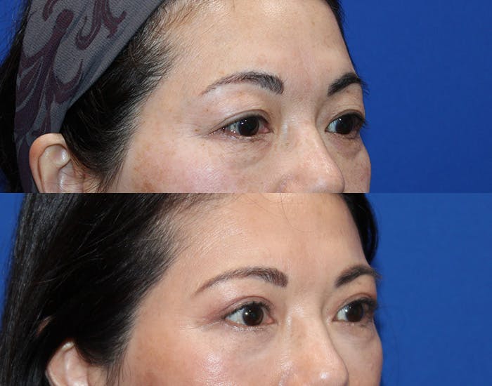 Lower Blepharoplasty Before & After Gallery - Patient 911425 - Image 6