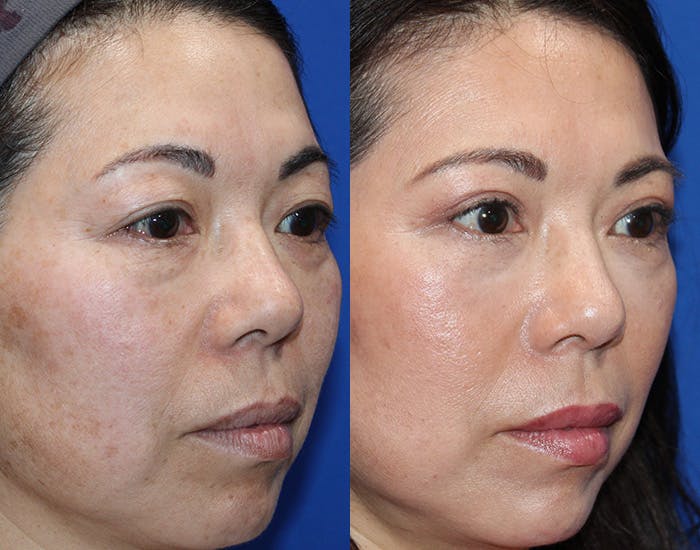 Upper Blepharoplasty Before & After Gallery - Patient 333545 - Image 5