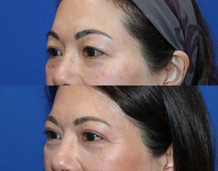 Lower Blepharoplasty Before & After Gallery - Patient 911425 - Image 4