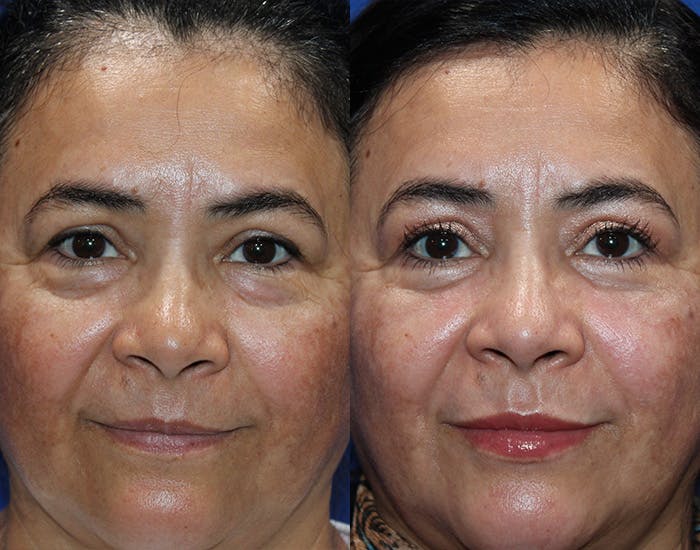 Lower Blepharoplasty Before & After Gallery - Patient 114018 - Image 1