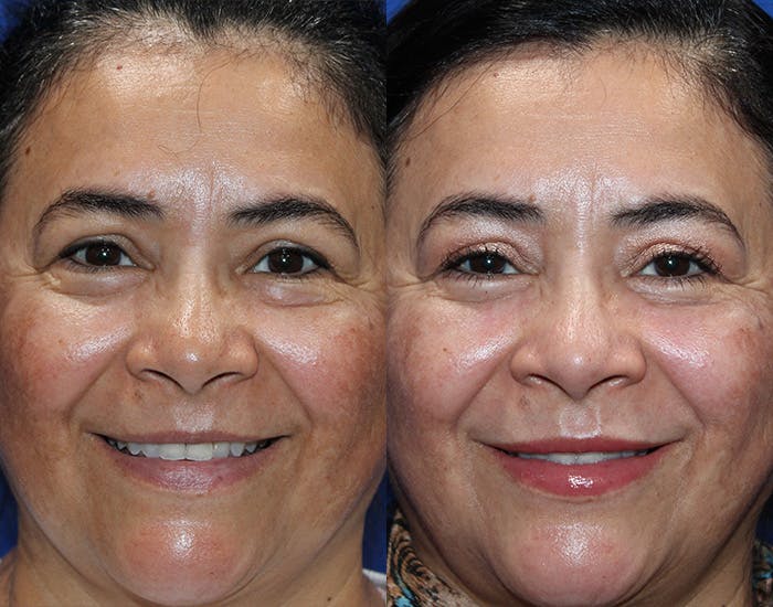 Lower Blepharoplasty Before & After Gallery - Patient 114018 - Image 3