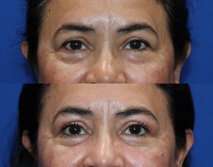 Lower Blepharoplasty Before & After Gallery - Patient 114018 - Image 2