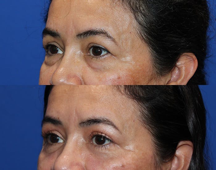 Lower Blepharoplasty Before & After Gallery - Patient 114018 - Image 6