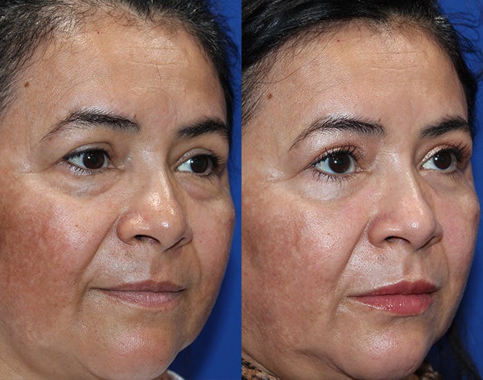 Lower Blepharoplasty Before & After Gallery - Patient 114018 - Image 7