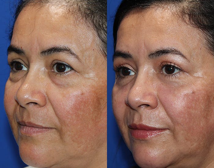 Lower Blepharoplasty Before & After Gallery - Patient 114018 - Image 5