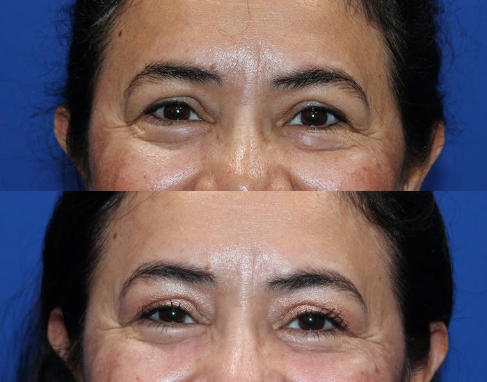 Lower Blepharoplasty Before & After Gallery - Patient 114018 - Image 4
