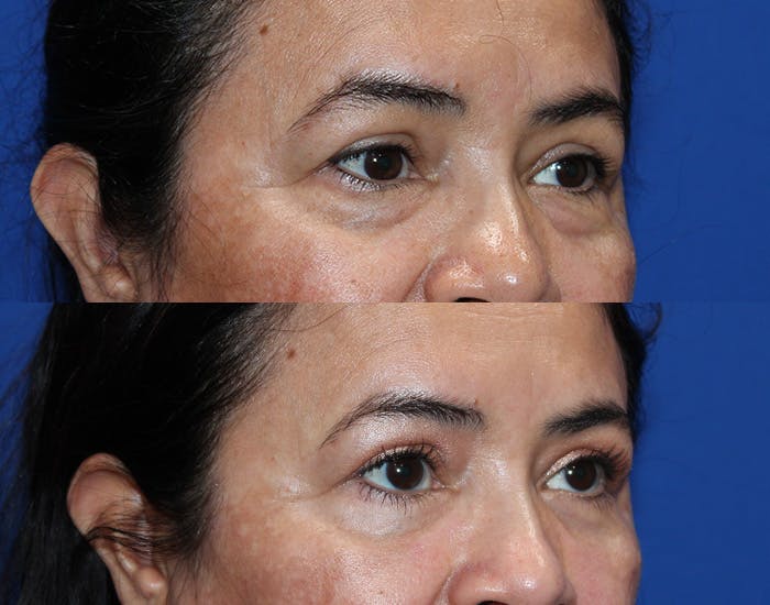 Lower Blepharoplasty Before & After Gallery - Patient 114018 - Image 8