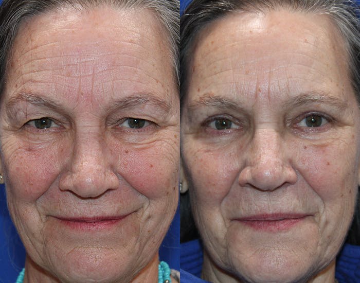 Lower Blepharoplasty Before & After Gallery - Patient 283928 - Image 1