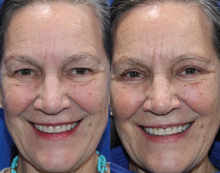 Upper Blepharoplasty Before & After Gallery - Patient 179101 - Image 3
