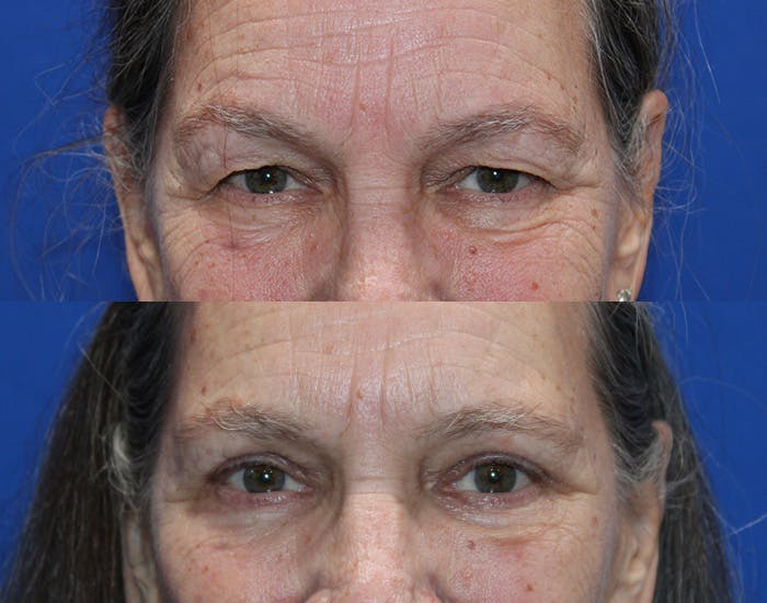 Upper Blepharoplasty Before & After Gallery - Patient 179101 - Image 2