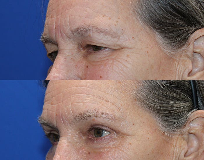Lower Blepharoplasty Before & After Gallery - Patient 283928 - Image 6