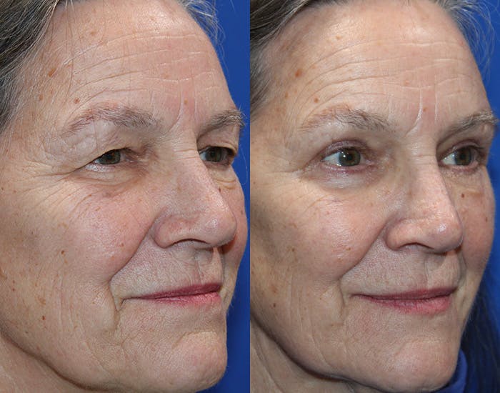 Lower Blepharoplasty Before & After Gallery - Patient 283928 - Image 7