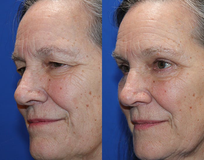 Upper Blepharoplasty Before & After Gallery - Patient 179101 - Image 5
