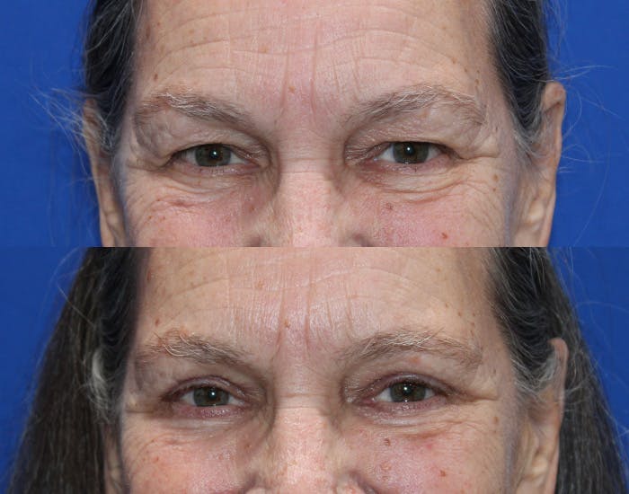 Lower Blepharoplasty Before & After Gallery - Patient 283928 - Image 4