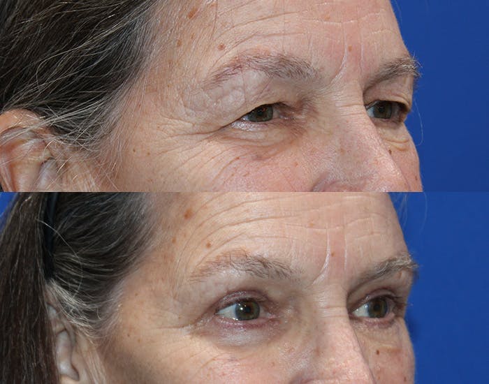 Lower Blepharoplasty Before & After Gallery - Patient 283928 - Image 8