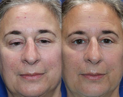 Ptosis Repair Before & After Gallery - Patient 421010 - Image 1