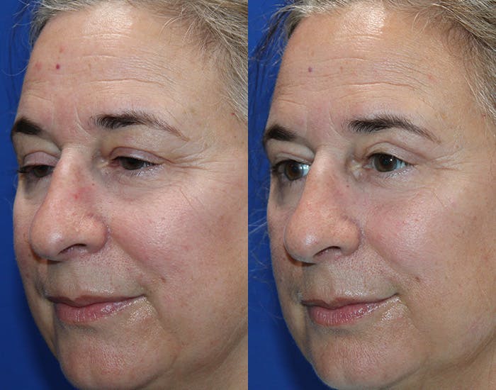 Ptosis Repair Before & After Gallery - Patient 421010 - Image 3