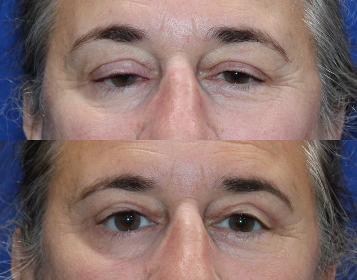 Ptosis Repair Before & After Gallery - Patient 421010 - Image 2