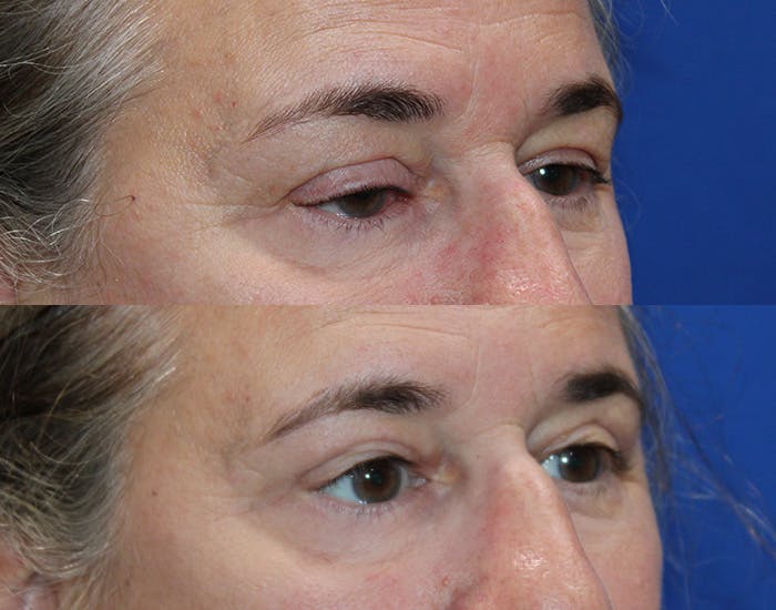 Ptosis Repair Before & After Gallery - Patient 421010 - Image 6