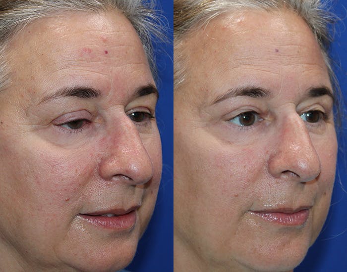 Ptosis Repair Before & After Gallery - Patient 421010 - Image 5