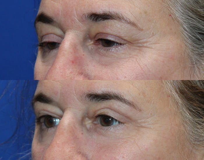 Ptosis Repair Before & After Gallery - Patient 421010 - Image 4