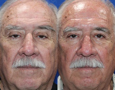 Ptosis Repair Before & After Gallery - Patient 286681 - Image 1