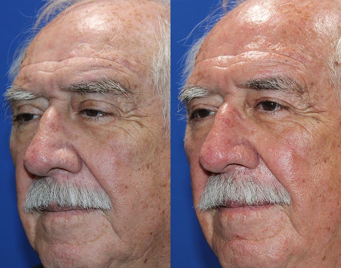 Ptosis Repair Before & After Gallery - Patient 286681 - Image 3
