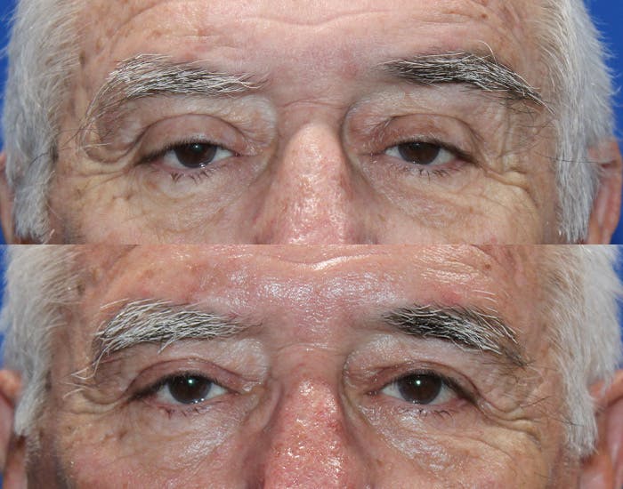 Ptosis Repair Before & After Gallery - Patient 286681 - Image 2