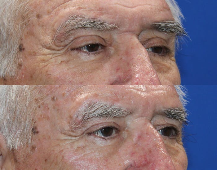 Ptosis Repair Before & After Gallery - Patient 286681 - Image 6
