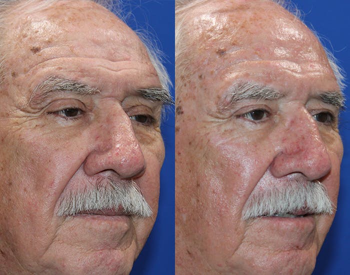 Ptosis Repair Before & After Gallery - Patient 286681 - Image 5