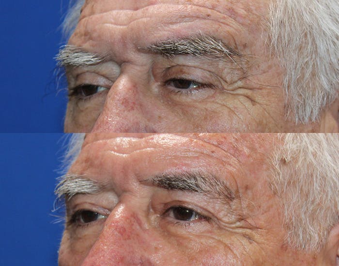 Ptosis Repair Before & After Gallery - Patient 286681 - Image 4