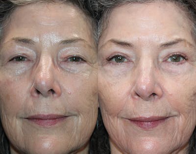 Ptosis Repair Before & After Gallery - Patient 223474 - Image 1