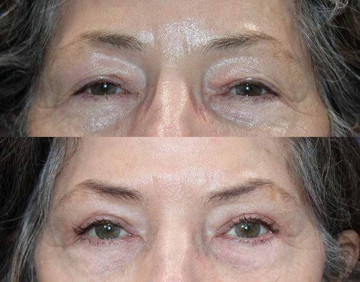 Ptosis Repair Before & After Gallery - Patient 223474 - Image 2