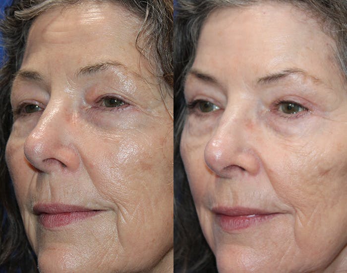 Ptosis Repair Before & After Gallery - Patient 223474 - Image 3